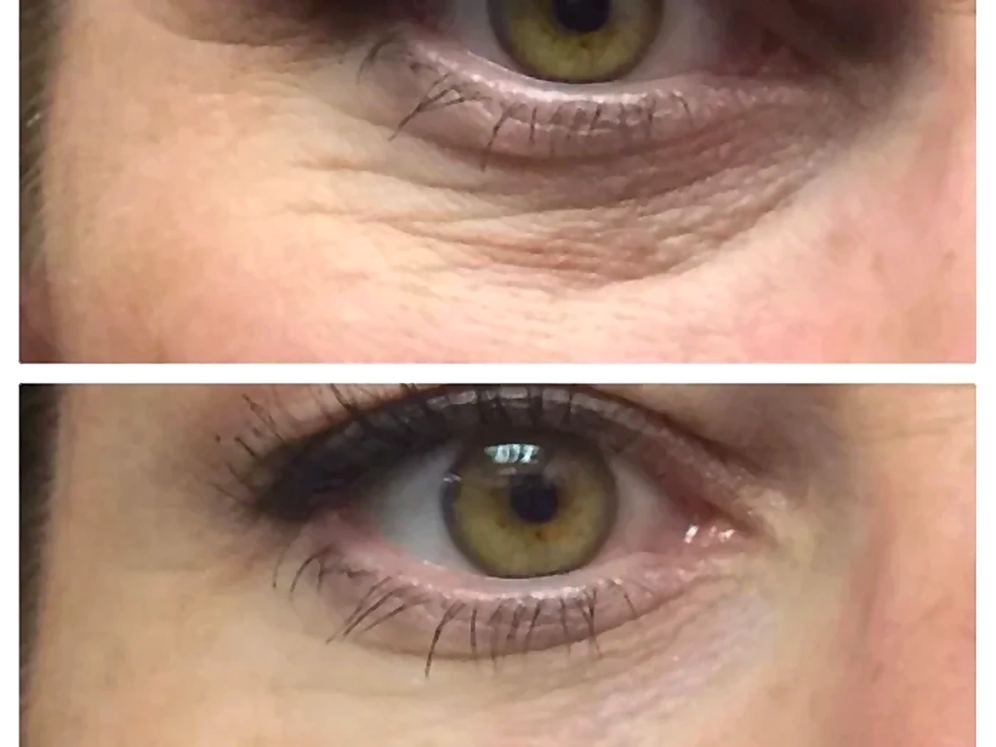 Blépharoplastie - exemple 2