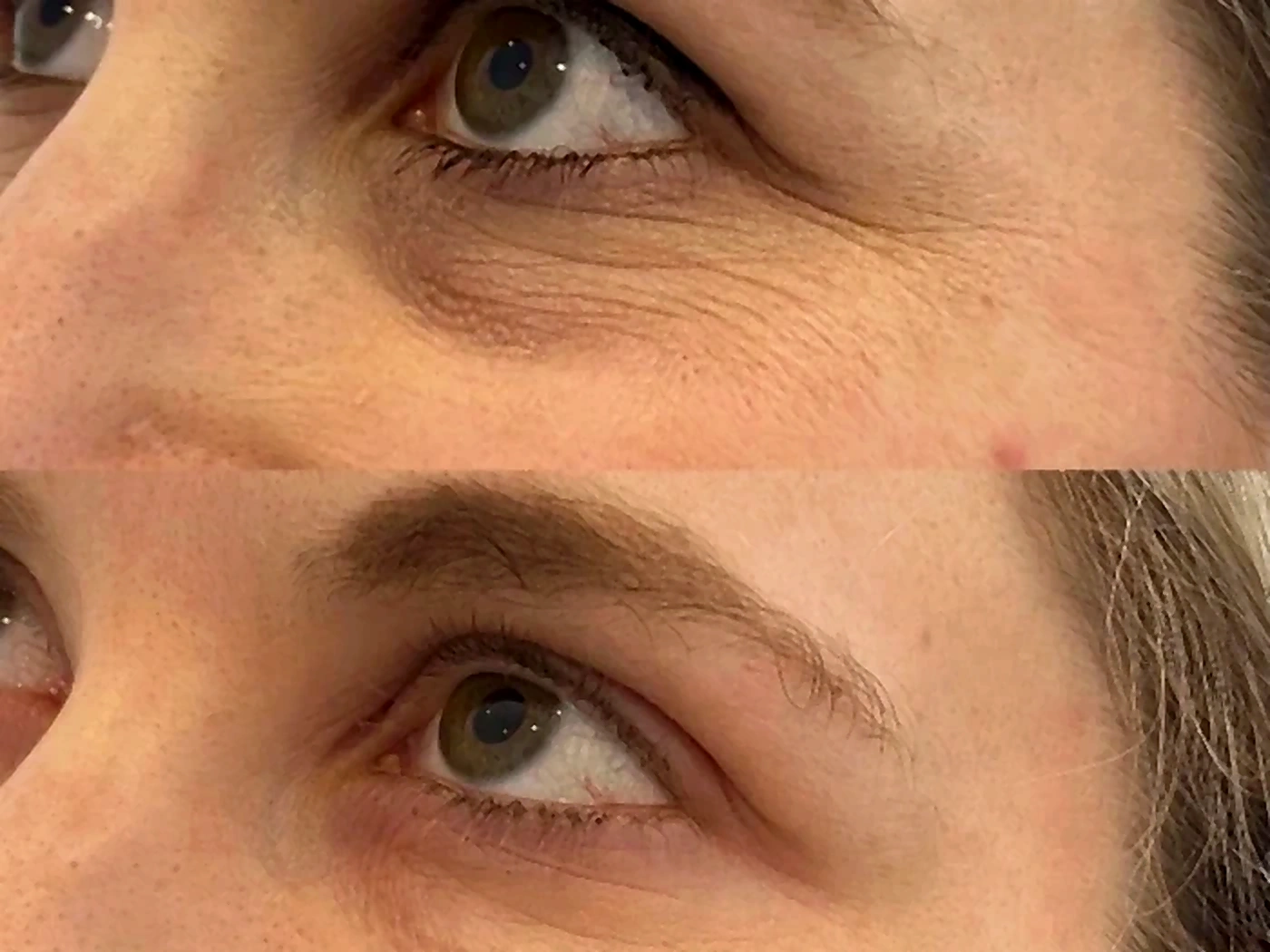 Blépharoplastie - exemple 3