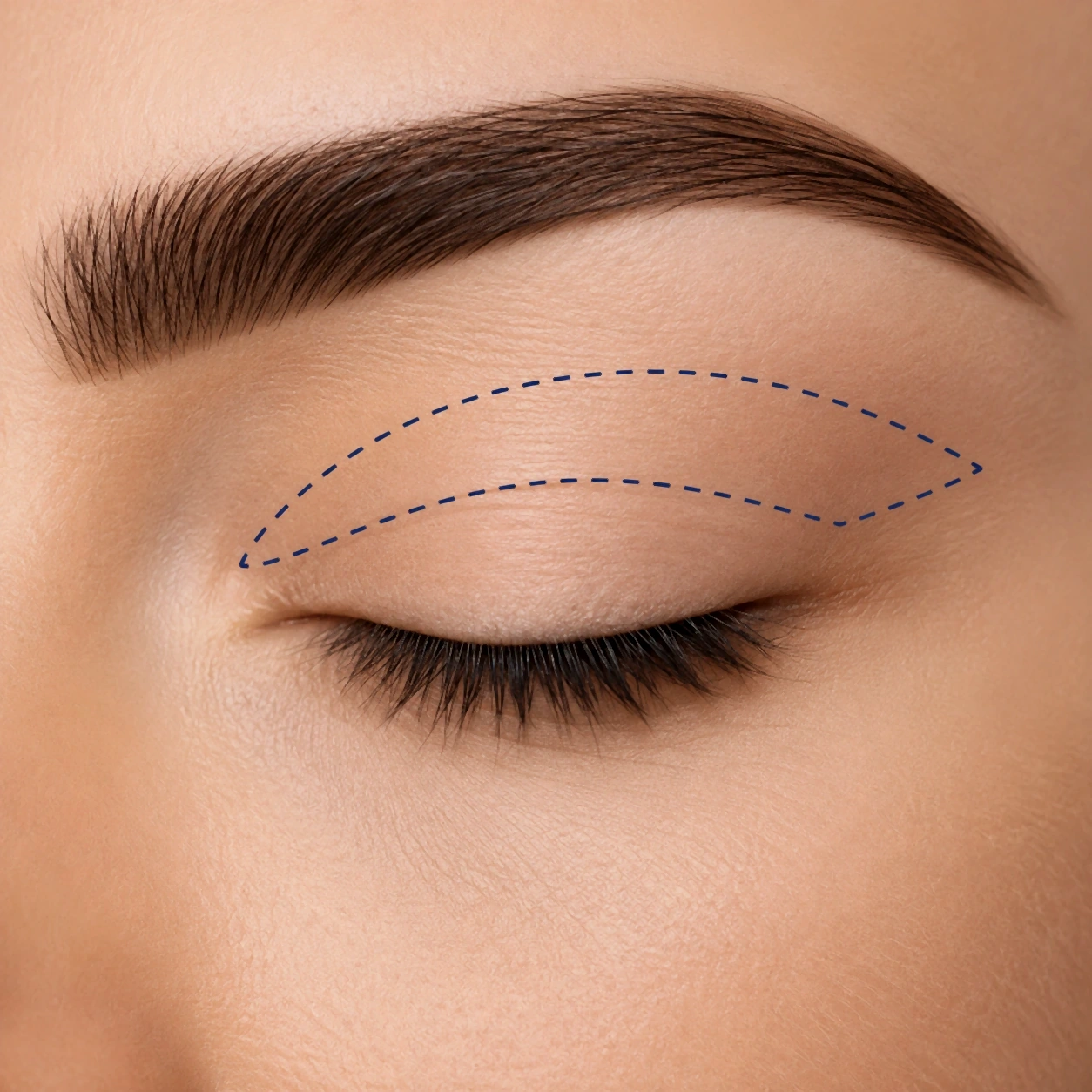 Blépharoplastie - schéma de correction de la paupière supérieure