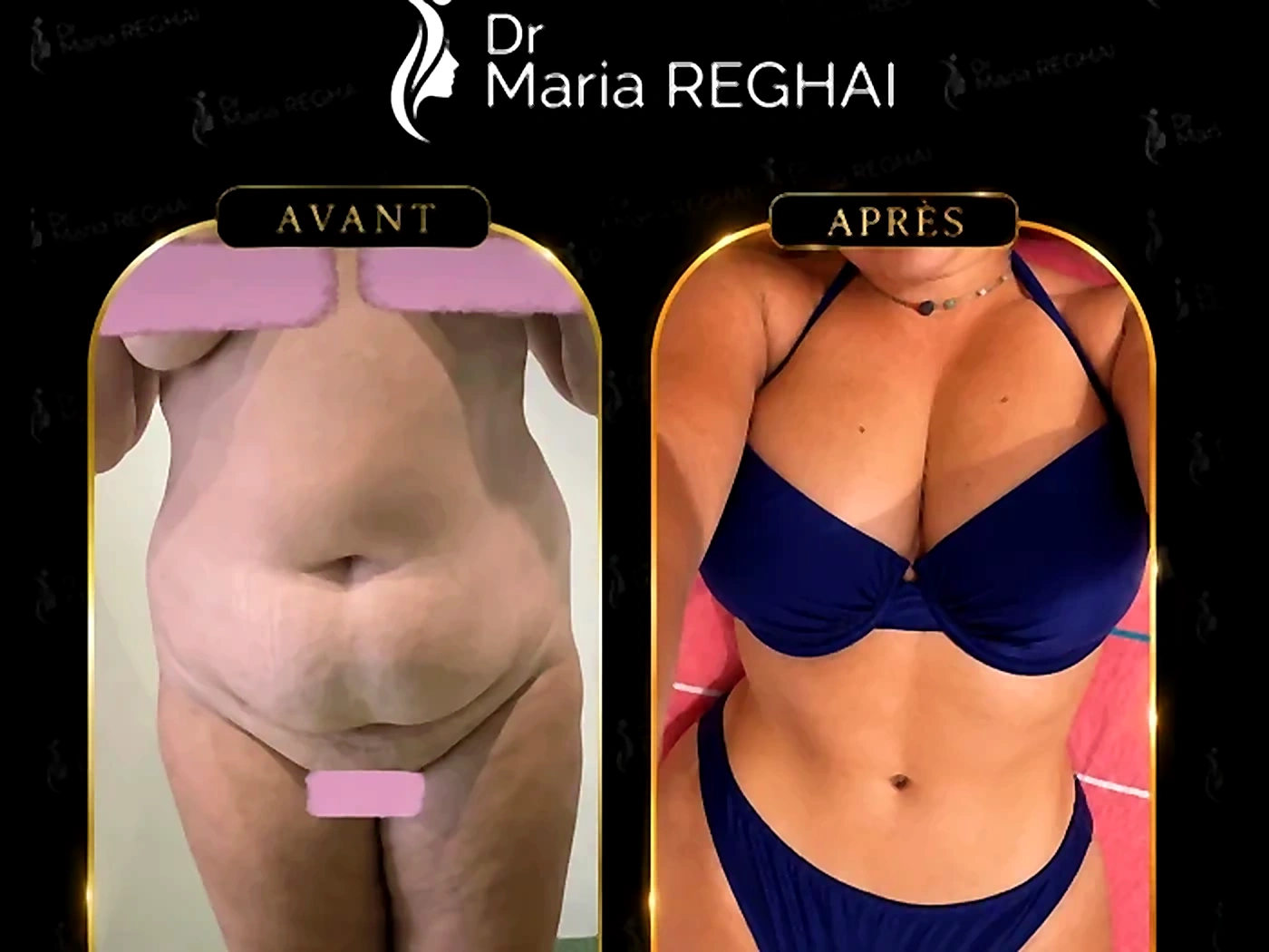 Avant/après Abdominoplastie - exemple 2