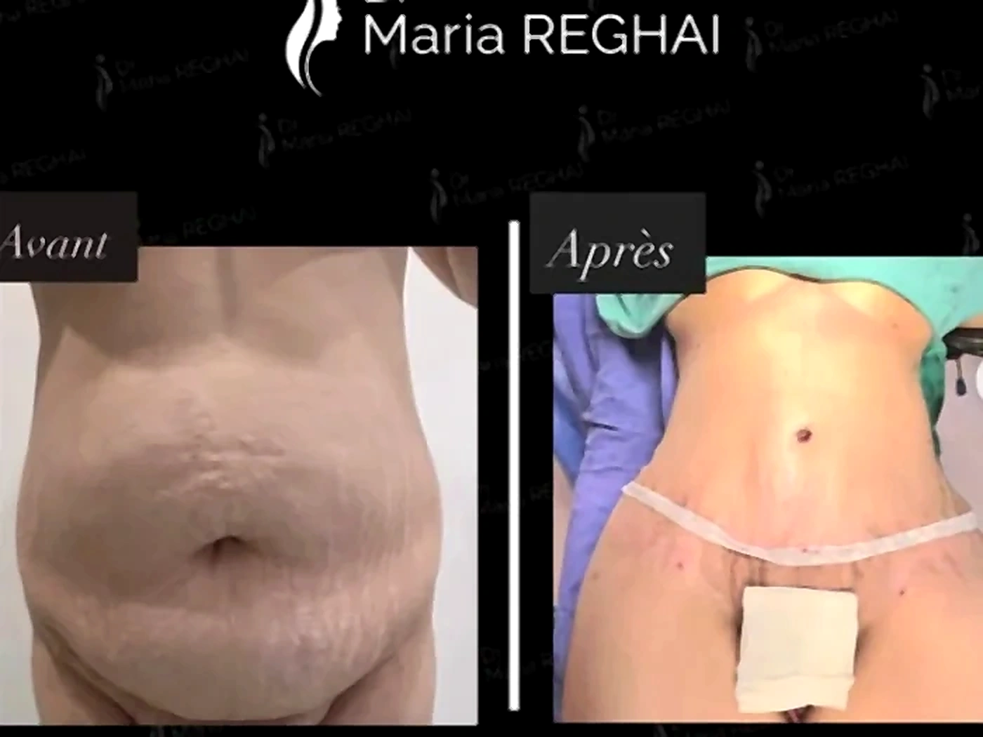 Avant/après Abdominoplastie - exemple 1