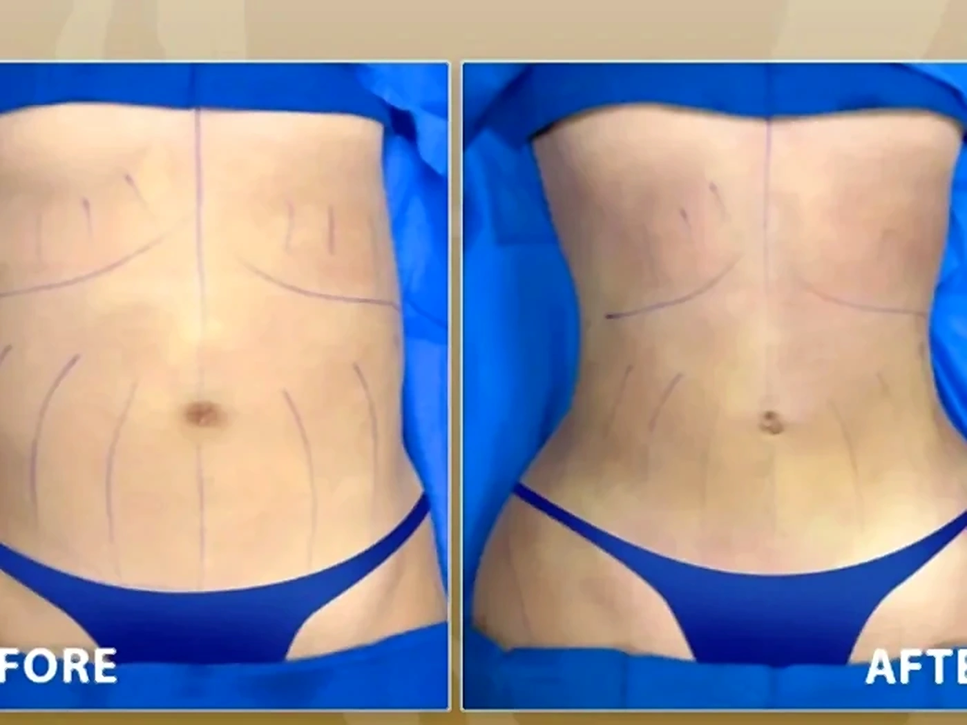 Body Contouring - Dr Maria Reghai