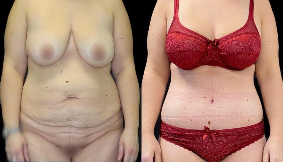Body Lift - Dr Maria Reghai