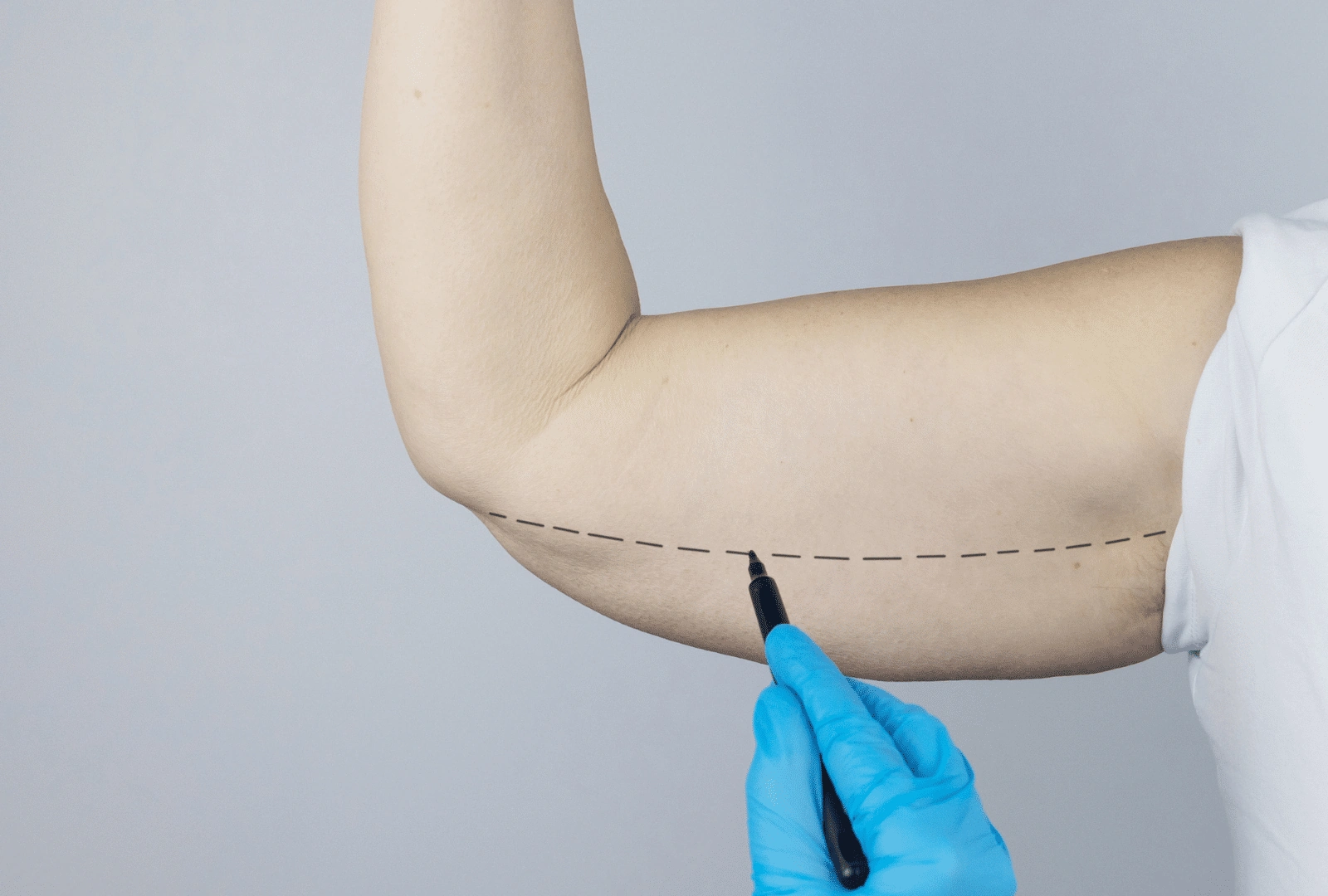 Avant/après Lifting Cuisses et Bras