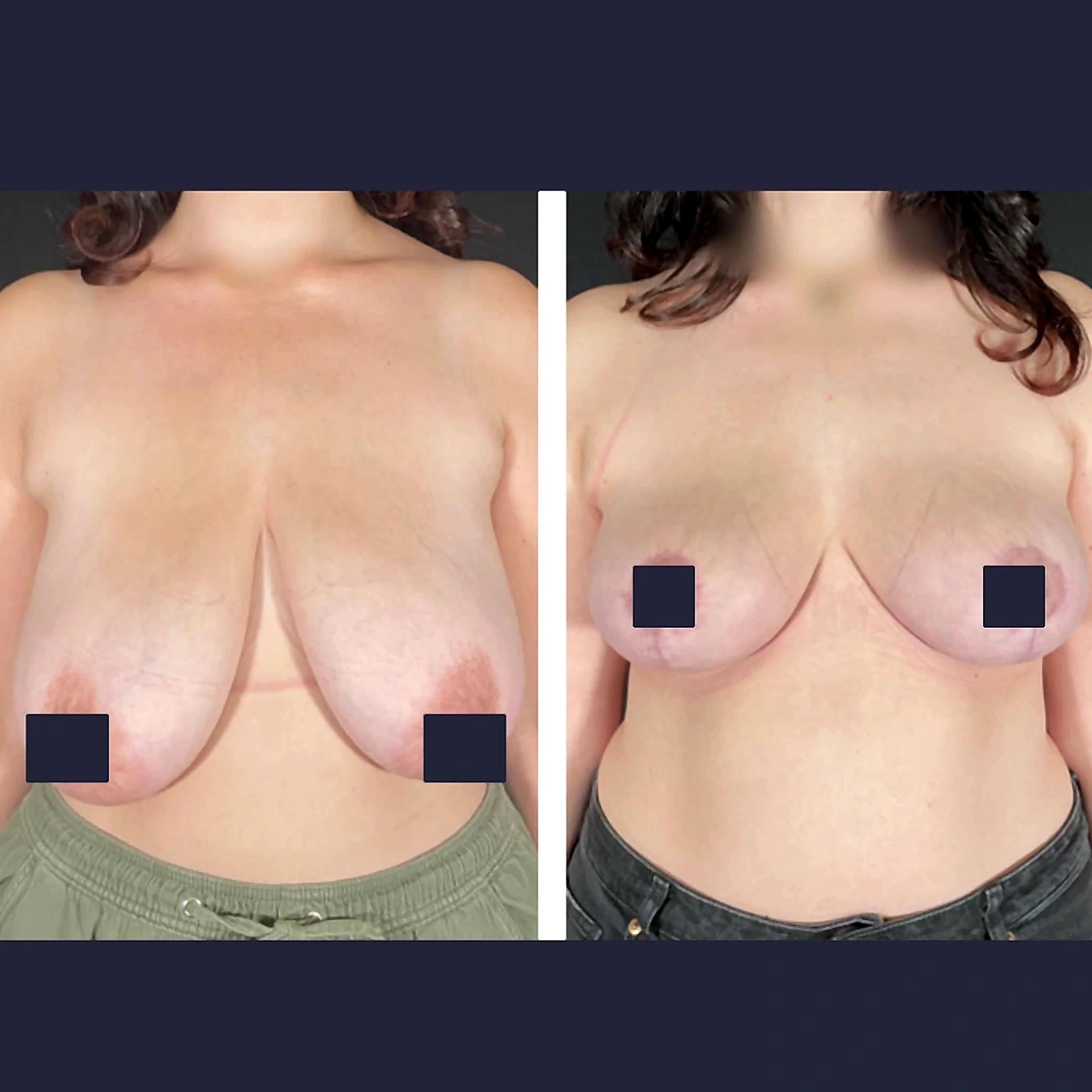 Chirurgie Mammaire - exemple 1