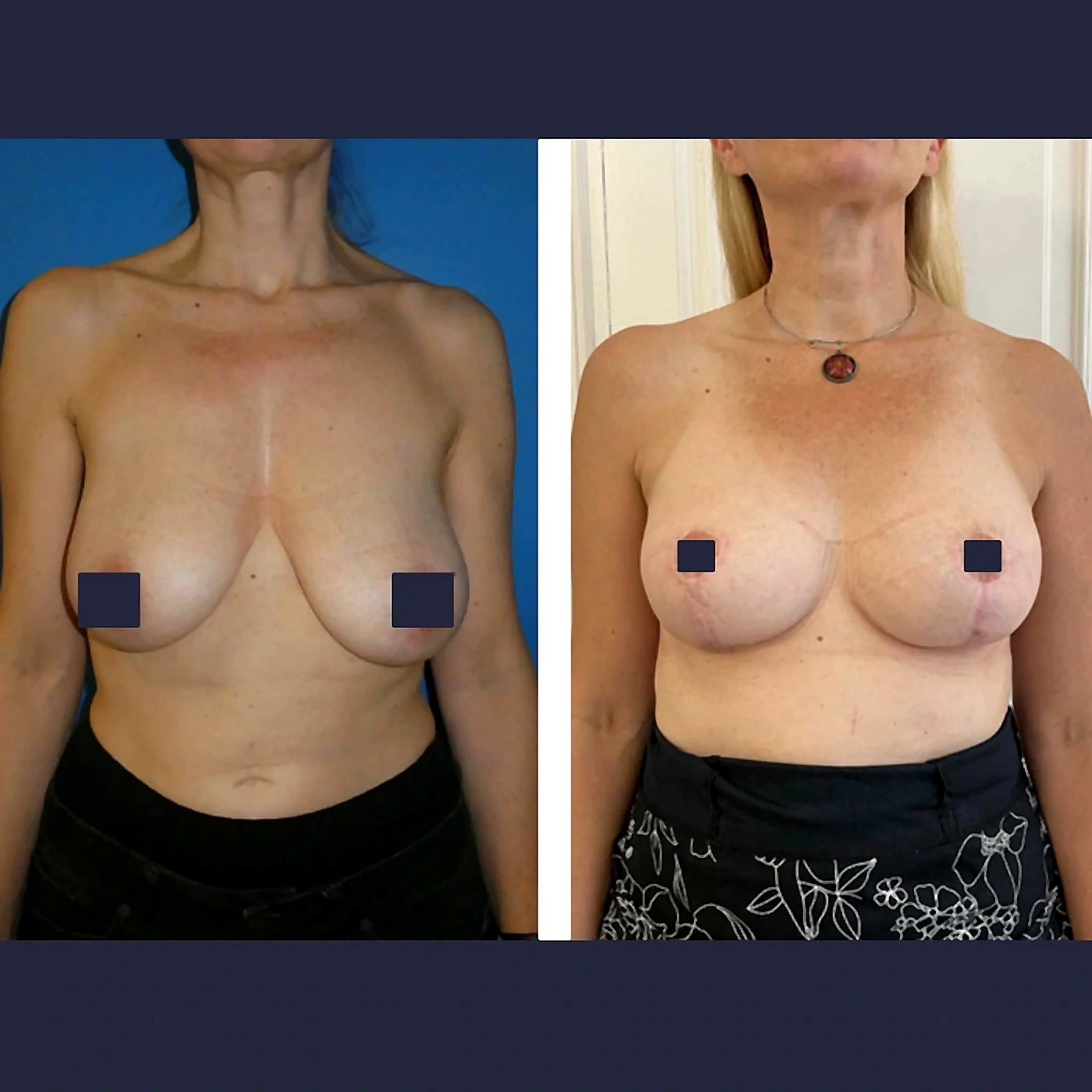 Chirurgie Mammaire - exemple 2