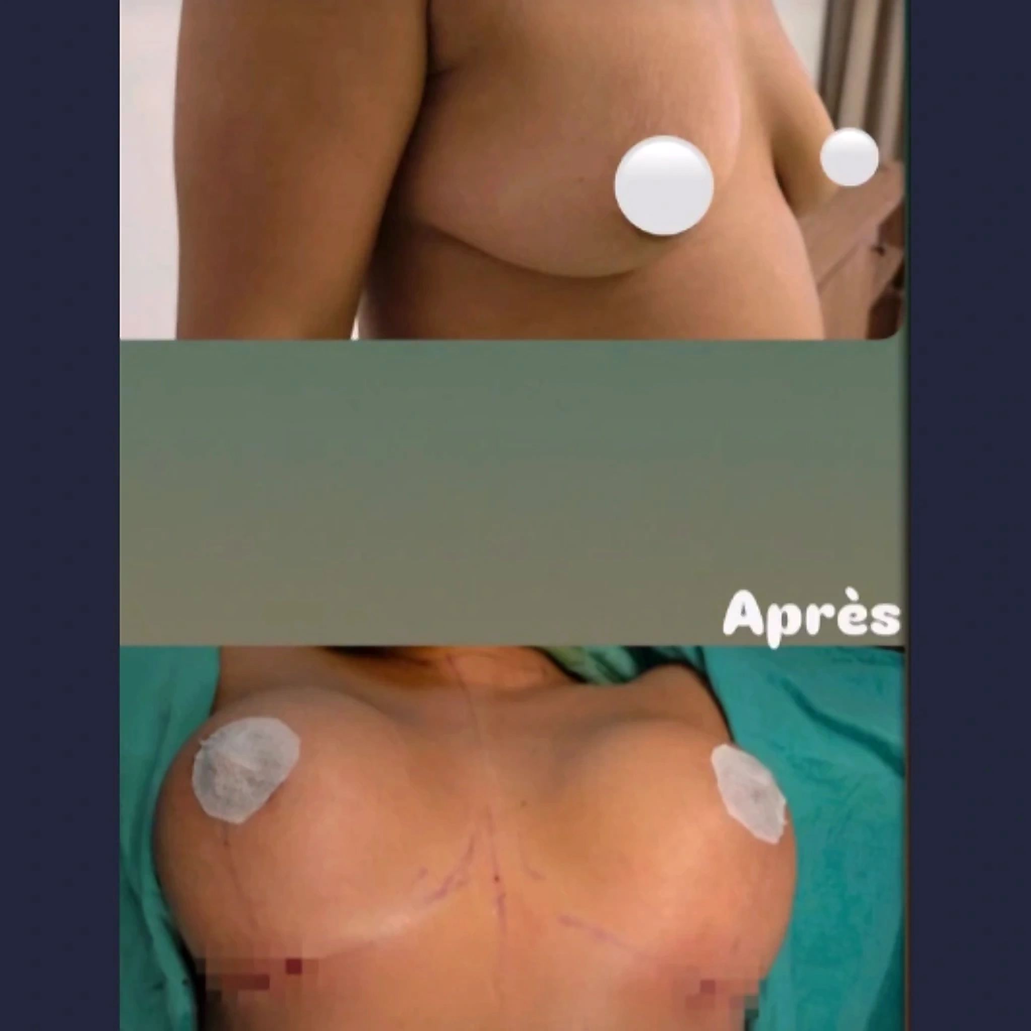 Chirurgie Mammaire - exemple 3