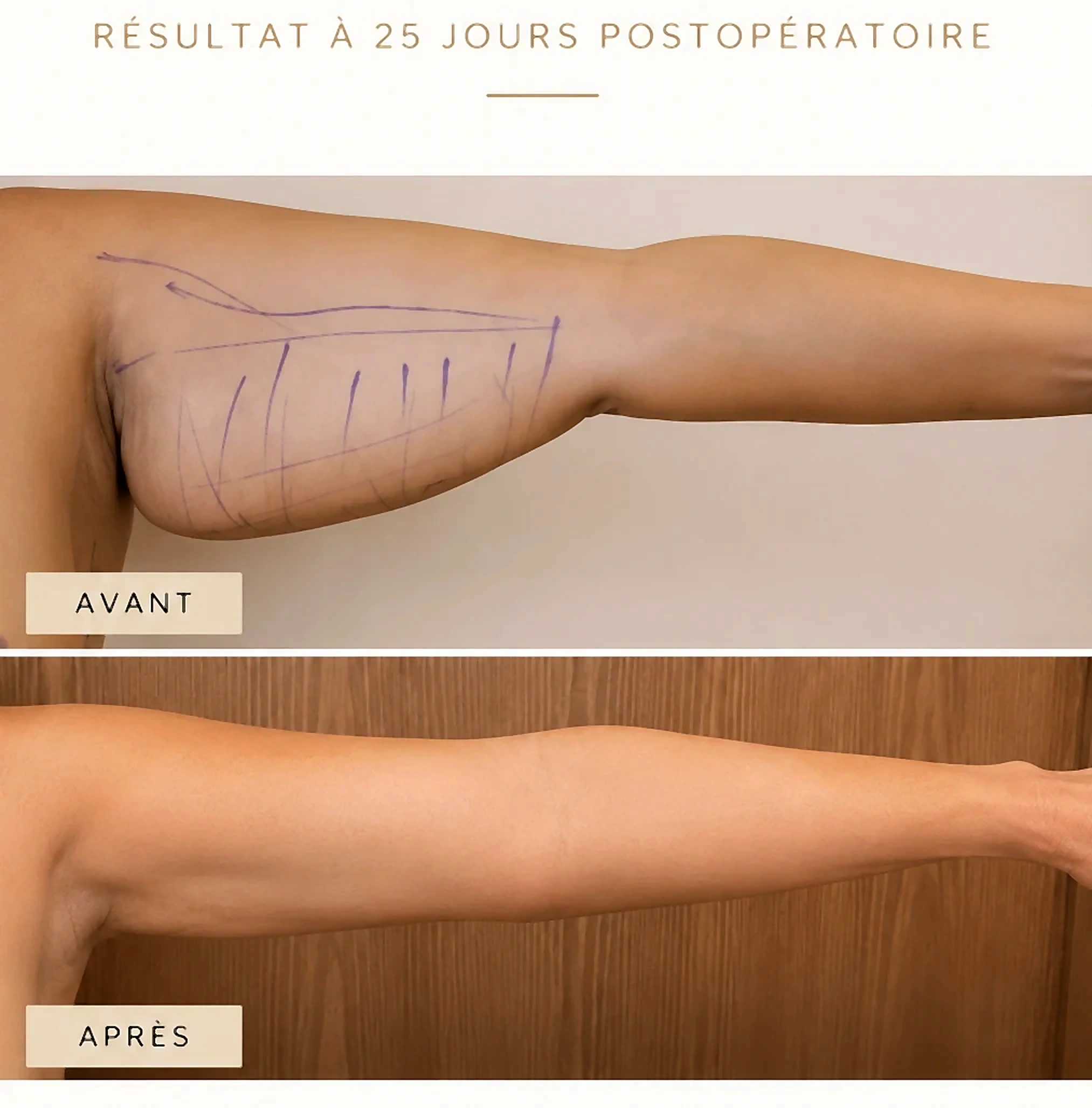 Avant et après — Liposuccion des bras — Technique J Plasma