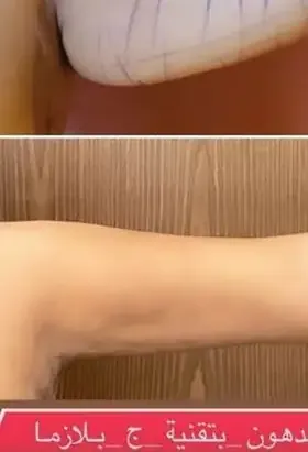 Avant liposuccion des bras technique J Plasma