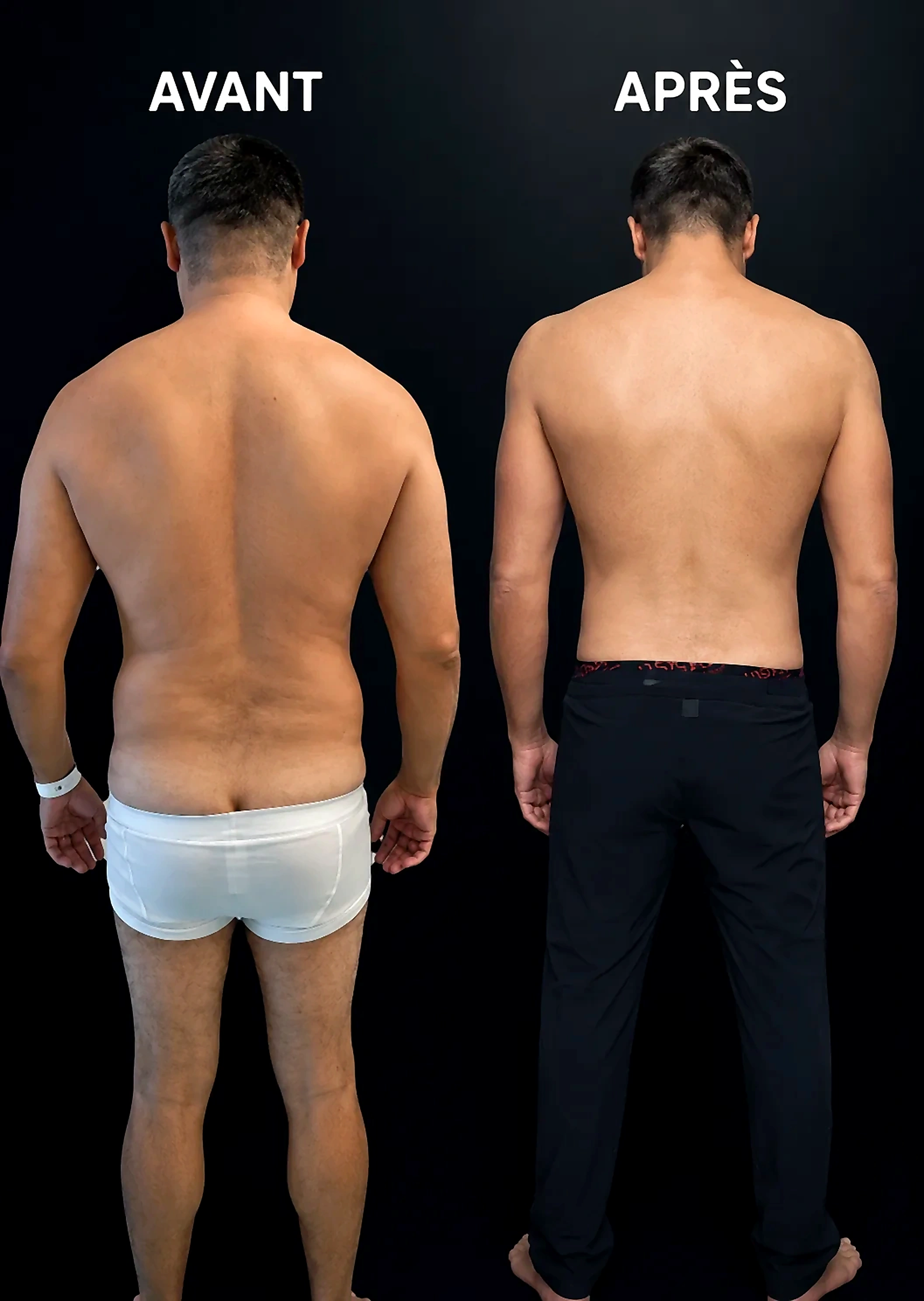 Avant / Après — liposuccion masculine