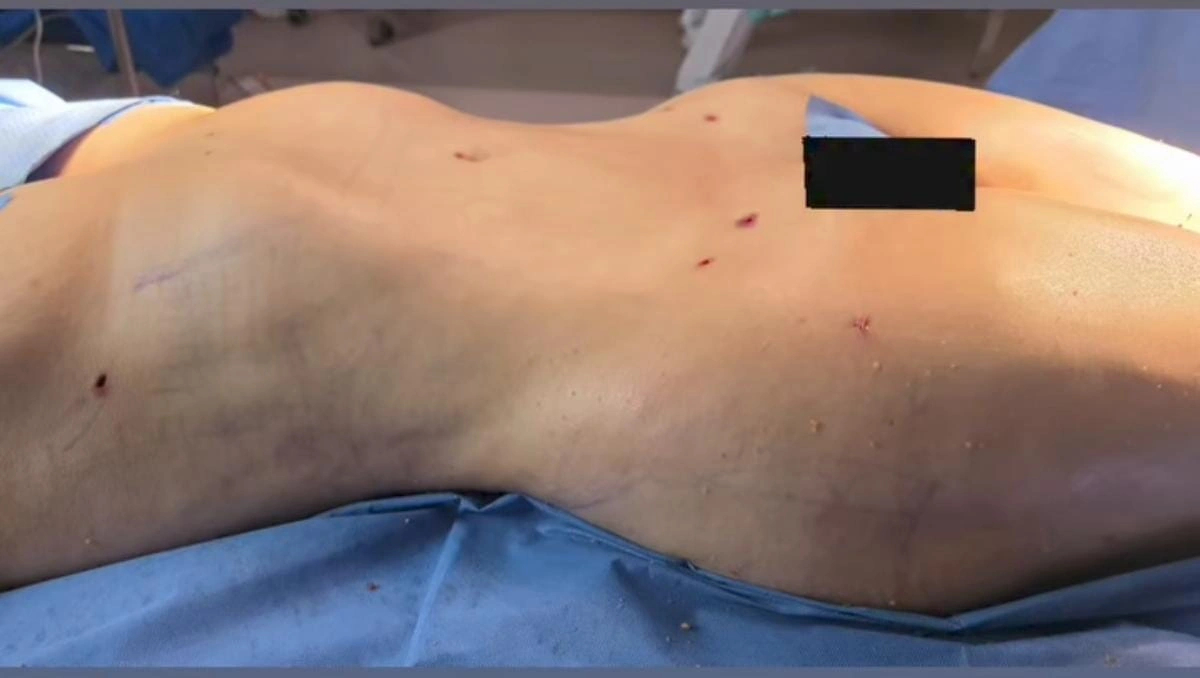 Liposuccion et lipofilling des fesses