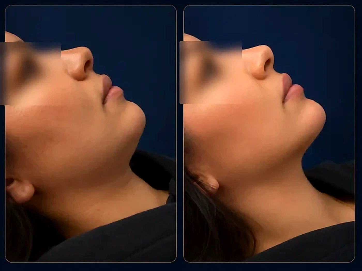Lifting Visage - Dr Maria Reghai